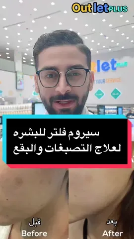 سيروم فلتر للبشره لعلاج التصبغات والبقع وآثار الحبوب #دكتور_احمد_زكي #outlet_plus #fyp #الشعب_الصيني_ماله_حل😂😂 