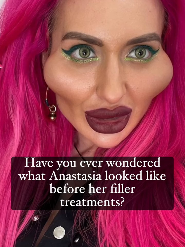 In some cases, an excessive use of filler can create an unnatural look. Anastasia is well-known for her “over-filled” appearance, and many have observed that her cosmetic specialists are partially accountable. Here at Skin Vitality, we believe in being open, honest, and ethically responsible with our patients when it comes to dermal filler. What's your take? Share your thoughts below! ⬇️ #facialtransformation #facialbalancing #dermalfiller #cheekfiller #chinfiller #jawlinefiller