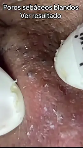 #extractions #puntosnegros #acne #grasa #espinillas #granos #poros #pelo #Folículo #relajante #facial #extraccion 