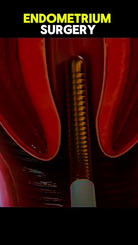 Endometrium Surgery Procedure 3d animation videoEndometrial ablation is a procedure to remove a thin layer of tissue (endometrium) that lines the uterus. It is done to stop or reduce heavy menstrual bleeding. #endometriosis #endometrium #endometrialcancer #ablation #endometrialbiopsy #CapCut