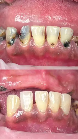 The dramatic transformation of these teeth before and after fillings.  If you didn’t know, this is what tooth decay looks like in a smoker’s mouth. Do you have similar cavities? Get them fixed now! Call or whatsapp us at  ☎️ 017-451 5155   #dental #dentaltok #dentist #seremban #dentistseremban #serembandentist #fyp #foryoupage #dentalmy #oralhealth #Dentistry #filling #toothfilling 