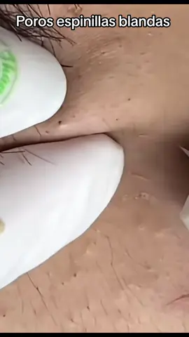 #extractions #puntosnegros #acne #grasa #espinillas #granos #poros #pelo #Folículo #relajante #facial #extraccion 