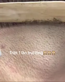 Và khi đặt tâm huyết vào trong nghề và em lựa chọn những thứ tốt nhất cho SPA của em. Và một trong những thứ làm nên THÀNH CÔNG của em đó là máy triệt lông lạnh đắt nhất khu vực.. Mọi người luôn nghĩ TRIỆT LÔNG là dịch vụ phễu vì thế thường mua máy rẻ và làm qua loa. Nhưng với em khi khách đã bỏ tiền ra thì mọi dịch vụ đều là chính.. EM muốn khách được trải nhiệm mọi thứ tốt nhất. Đầu tư máy đắt tuy tốn tiền thật đó nhưng mang lại cho khách những thứ như sau : 👉 𝑇𝑖𝑒̂́𝑡 𝑘𝑖𝑒̣̂𝑚 𝑡ℎ𝑜̛̀𝑖 𝑔𝑖𝑎𝑛 đ𝑖 𝑙𝑎̣𝑖 𝑣𝑖̀ 𝑚𝑎́𝑦 đ𝑎̆́𝑡 𝑠𝑒̃ 𝑙𝑎̂𝑢 𝑙𝑒̂𝑛 👉 𝑇𝑟𝑖𝑒̣̂𝑡 𝑙𝑎̣𝑛ℎ 𝑣𝑎̀ 𝑘ℎ𝑜̂𝑛𝑔 ℎ𝑒̂̀ 𝑛𝑜́𝑛𝑔 ℎ𝑎𝑦 𝑟𝑎́𝑡 👉 Đ𝑎̂̀𝑢 𝑡𝑟𝑖𝑒̣̂𝑡 𝑚𝑎̣̆𝑡 𝑣𝑎̀ 𝑏𝑜𝑑𝑦 𝑟𝑖𝑒̂𝑛𝑔 𝑛𝑒̂𝑛 𝑟𝑎̂́𝑡 𝑠𝑎̣𝑐ℎ 𝑠𝑒̃ 👉 𝑆𝑎𝑢 1𝑙𝑡 𝑑𝑎 𝑚𝑜̛̀ 𝑡ℎ𝑎̂𝑚 𝑚𝑖̣𝑛 𝑏𝑎̂́𝑡 𝑛𝑔𝑜̛̀.. 👉 𝑃ℎ𝑜̀𝑛𝑔 𝑟𝑖𝑒̂𝑛𝑔  #Hienhonghac #Celybeautylab #aesthetic #filler #botox #mesotherapy #celybeautyandskinlab 