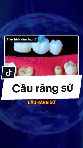 phục hình cầu răng sứ. #LearnOnTikTok #antoannhakhoa #rang 