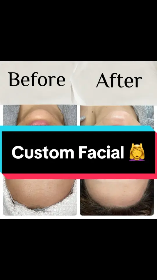 Custom Facial to help with dry skin, acne, and sunspots🌼 @GlyMed Plus Skincare @TiZO Skin #facial #medicalgradeskincare #glymedplus #glymedprofessional #cleanskin #sunscreen #fyp #repost #medicalaesthetics #facewash #gentelfacewash #dryskin 