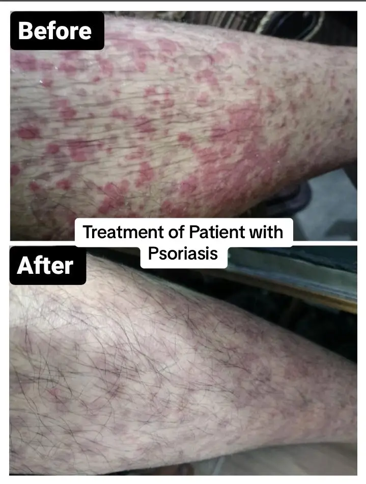 Wonderful Results for Patient suffering from Psoriasis in just 1 month .