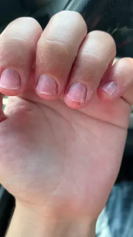 contrary to the sound i developed this allergy from doing my nails at home with supplies i bought on amazon 😭 stay safe yall #nailallergy #contactdermatitis #gelnails #gelnailsathome #gelnailallergy #acrylicallergy 