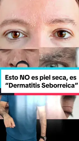 #dermatitisseborreica #dermatitis #drwilfridosolanoderma #dermatology #AprendeEnTikTok #dermatologomachala #dermatips #dermatologoecuador #drwilfridosolano 
