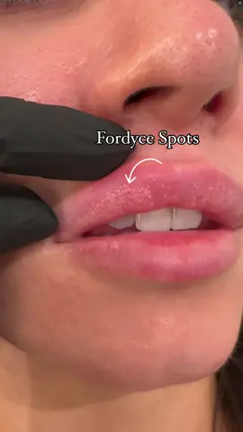 Fordyce Spots are normal oil glands that can be found on your lips. They are believed to be caused by sebum; our natural oil of the skin that can get trapped in a sebaceous gland that does not have hair. They may appear more pronounced after having lip filler due to adding volume and stretching of the skin. #fyp #losangeles #medspa #pasadena #fordyce #oilglands #lipfiller #botox #aesthetic 