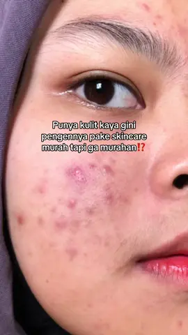 Mending langsung pake 1 set gini biar ga pusing lagi gimana cara ngatasin jerawat😚🫶🏻✨#acnefighter #acneskin #acne #skincareroutine #skincare 