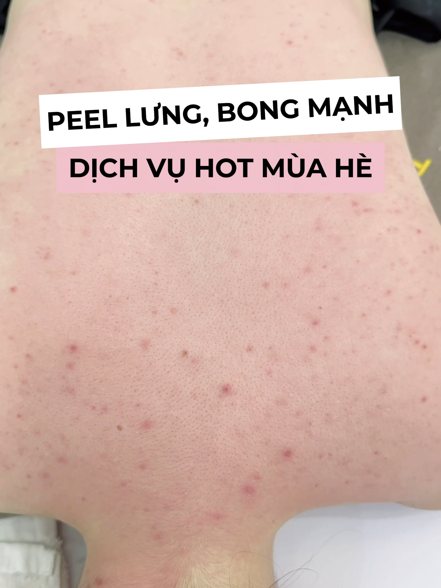 Peel một lần thì lưng mụn bao nhiêu cũng chấm dứt #rosedebeaute#lamdepda#myvanbeaute#dieutrida#GocLamDep#dieutridachuyensau#kienthuc #trimunlung#munlung#sanphamcaithienmunlung #peelmunlung #peel