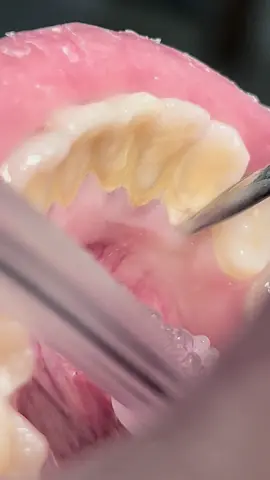 Scaling calculus and tartar from teeth #dentist #scaling #dentista #dental #usa 