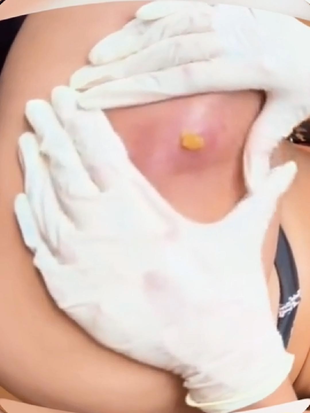 This location causes extremely painful acne #acne#pimples #pimplepop#popping#pimple #relaxing