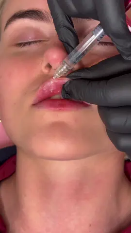 Kissable lips! 👄💉 #lips #iconlip #lipfiller #lipsoftheday #russianlips #foryoupage #fyp #aesthetics #aestheticpractitioner 