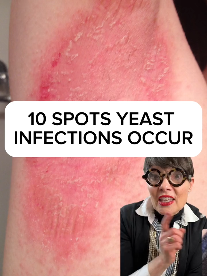 Here are 10 spots on the body that #yeastinfections can occur #yeastinfection #yeast