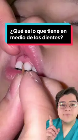 ¿Qué es lo que tiene en medio de los dientes? #quees #dientes #niños #dentista #elsalvador #odontologo 