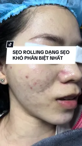 Trị sẹo hiệu quả = Phân biệt đúng dạng sẹo + tìm phương pháp phù hợp dạng sẹo + nơi trị uy tin + kiên trì tuân thủ! Chúc các bạn cải thiện sẹo tự tin hơn ❤️ #seoro #dranvi #seolom #triseoro #scar #triseorohcm #cachtriseoro #triseouytinsaigon #bocphotdranvi 