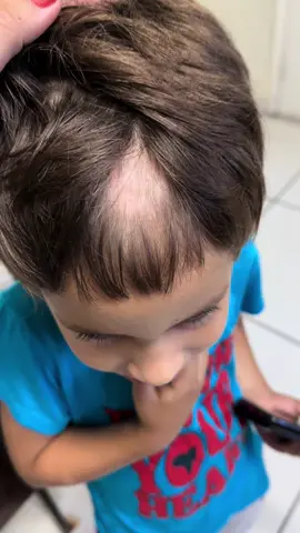 #tinhacapitis #courocabeludo #micosecourocabeludo #alopecia#micosis #tricologiamedica #monicacohendermatologista 