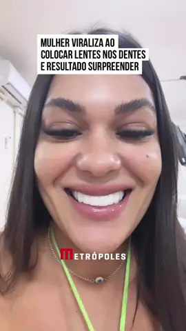 O antes e depois de colocar #lentes de resina nos dentes surpreendeu os internautas. Uma mulher postou um vídeo em que mostra o resultado do #procedimento, mas parece não ter ficado do jeito que imaginou. Na internet, os internautas não perdoaram e comentários como: 