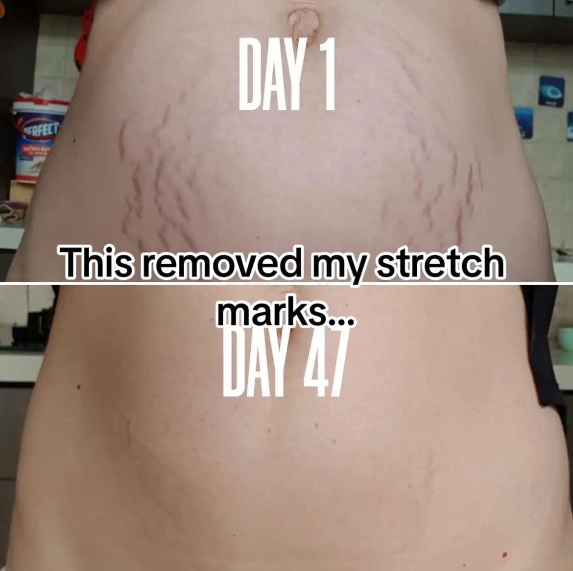 #fyp #stretchmarks #girl 