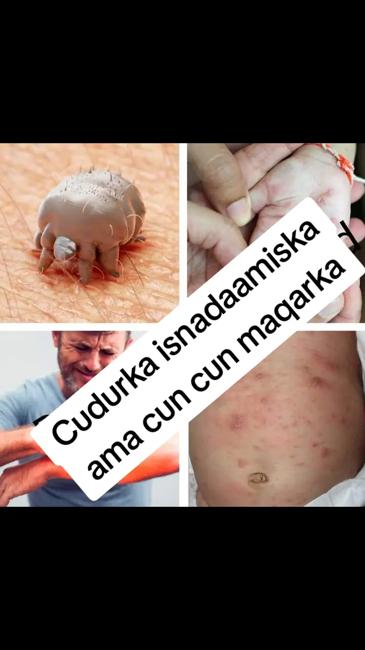 🔎Waa maxay isnidaamis? Scabies ✅ Isnidaamiska waa cudur caan ah oo ku dhaca bulshada qeebaheeda kala duwan waxaana keena noole il ma aragto ah oo ku nool dusha sare ee maqaarka halkaas oo uu dhigto ugxaantiisa kuna koro. ✅ Cudurkaan waxa uu caan ku yahay oo lagu gartraa nabro yay yar oo cun cun badan. ✅ Waxaa la qiyaasaa ku dhawaad 130 Milyan oo qof inay qabto cudurkaan guud ahaan caalamka, waxuuna uu u faafaa si toos ah (maqaarka qofka cudurka qabo inuu taabto kan caafimaadka qaba), sidoo kale waxaa lagu kala qaadaa in la wadaago dharka ama gogasha jiifka. ✅ Isnadaamisku kama yimaado nadaafad xumo. 🔎Maxaa lagu gartaa? 1️⃣ Isnidaamiska waxa uu caan ku yahay oo lagu yaqaan nabro yar yar iyo cun cun kaas oo habeenkii  ubadan. 2️⃣ Xoqidda joogtada ah waxay Keeni kartaa in qofka meesha uu xoqay yeelato caabuq kadibna infakshan qaado. ✅ Cudurkaan caruurta waxa uu kaga dhacaa  🔸Madaxa 🔸Wajiga 🔸Qoorta 🔸Calaacasha iyo cagta cad. Halka dadka waa ween uu kaga dhaco 🔸Xusulka 🔸Shaqfalaha 🔸Cumaacumta 🔸Ibta Nagaska 🔸Caloosha 🔸Xubinta Raga iyo xiniinyaha. 🔸Baridda 🔸Faraha dhaxdooda. Mararka qaar waxuu yeeshaa maqaarka nabro yar yar oo faruurac ah kuwaas oo u eg xasaasiyada misana leh cun cun badan oo uu qofku u bogaayo marka uu xoqaayo. Sidee looga hortagi karaa isnadaamiska? ☑️Habka ugu wanaagsan ee looga hortagi karo ayaa ah in la daaweeyo qofka cudurka qaba iyo dhamaan xubnaha kale ee qoyska ha qabeen cudurka ama yeeysan qabin.  ☑️ Hadaa isku aragtid dhamaan calaamadaha aan kor kusoo xusay la xariir dhaqtarka maqaarka si aad u heshid gar gaar caafimaad. #latashodhaqtarka_maqaarka🔎 #drugaas #wacyigalin #isnadaamis #somalia #scabies 