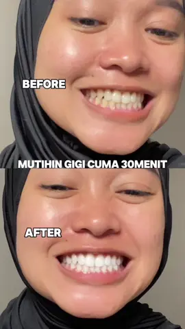 GAK USAH DI BLEACHING GAYSSS MAHAL. Mending pake ini aja Cuma 30 menit langsung putih! @Metoo Beauty  #pemutihgigi #metoosmile #metooPAP #metoostrips
