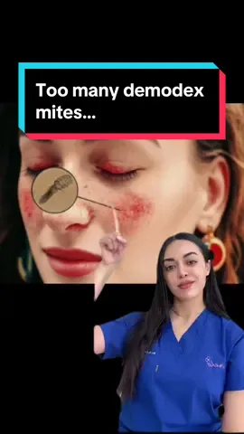An overpopulation of Demodex mites on the skin can lead to various conditions like rosacea, blepharitis, demodicosis, perioral dermatitis, and pityriasis folliculorum. These conditions result in symptoms such as redness, inflammation, itching, and skin irritation, often requiring medical treatment to reduce mite populations and alleviate symptoms. #demodex #mites #mite #parasites #rosacea #eczema #dermatitis #dryskin #oilyskin #skincare #foryou #foryoupage #fyp