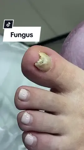 Toenail fungus! #nails #nailproblems #fungus #toenailfungus #fungusremoval 