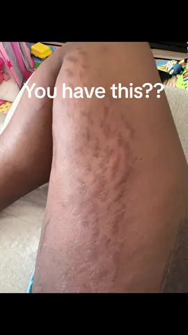 #stretchmarks #stretchmarkremoval #vergetures #peeling #skincare #stretchmark #skincare #skincareroutine #soindelapeau #foryou #foryoupage #foryourpage with patience we can do it!🫶🏽💪🏽💪🏽❤️@Dialuskin 