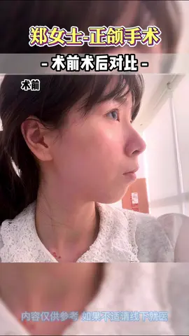 磨骨正颌#磨骨 #整形 #变美