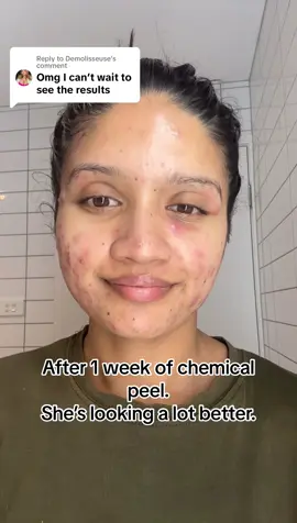 Replying to @Demolisseuse My skin is noticeably improving. Yet, those persistent cysts around my eyes remain a challenge. #skincareupdate #acne #acnetreatment #skinimprovement #acneisnormal #acnepositivity #acneproneskin #chemicalpeel #cyst #hormonal #fyp 