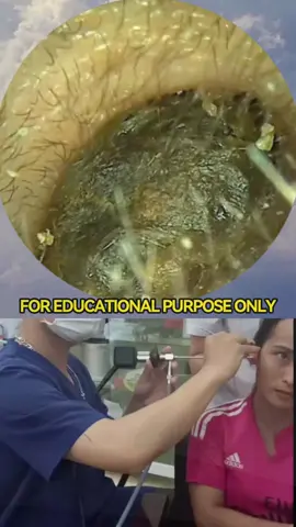 Full Video -> @earwax123 #earwax  #earwaxremoval  #earwaxcleaning
