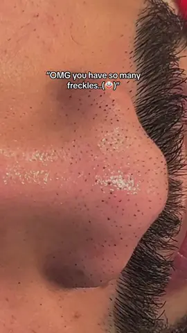 Freckles look good tho😭 #fyp #foryoupage #skincarereview #skincareroutine #skincareaddict #blackheadsremoval #glowskin #facecare #freckles 