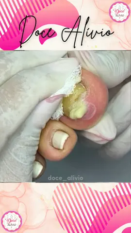 @Doce Alívio  #podologia #podologa #podolog #unhas #pedicure #podologiacomamor #manicure #saude #nails #pes #podology #saudedospes #unhaencravada #pies #foot #satisfatorio #tiktokviral #fyp