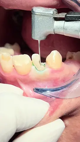Tooth composite restoration with Fiber post #dentist #dentista #dental #ttpd #usa 