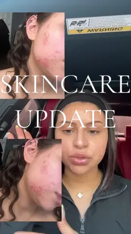 Its been about two weeks i believe, havent taken the doxys either. Happy with the results thus far 😇 #dermatologist #skincarejourney #acnetreatment #tretinoin 
