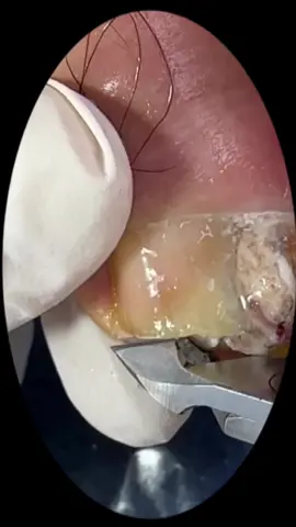 #podologia #unhas #unhaencravada #ingrowntoenail 