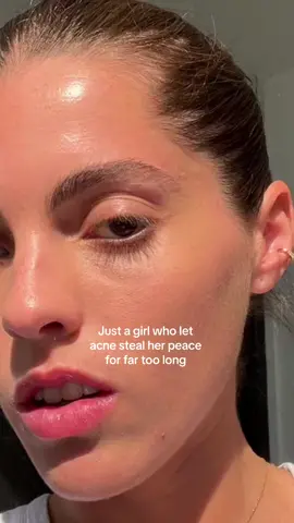 Was accutane always the plan? No, absolutely not. For me it was a last resort, while for many dermatologists, its the first thing perscribed. Was I excited about going on it? Well, yes. Once I got over the fear of it all & realized I needed an immediate relief from my acne.  Your mental health is precious material — do whats best for you to take care of it 🩷 #MentalHealth #mentalhealthmatters #MentalHealthAwareness #accutane #accutanejourney #isotretinoin #acnehealing #acneskin #acnescars #acnefighter #skinproblems #transformation #peaceofmind #dryskin 