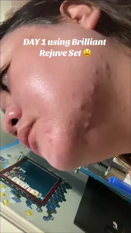 Just want to share how @Brilliant Skin Essentials Inc. helps me to get rid my severe acne breakouts and dark spots 🥹.  From Day 1 to Day 9! Real quick! Lumalabas labas pa ko nyan, I make sure na dala ko lagi yung Sunscreen ni Brilliant, also before applying make up I used it first and hindi naman din humuhulas make up ko! I also have Pcos that’s why Im suffering talaga from cystic acne, bumili nadin ako ng mga skincare na pricey and used it for months, pero hindi man lang naheal yung mga acne ko 😭, and then eto na since user naman talaga ko ng brilliant eversince, binalikan ko na yung pag gamit, for P300 only!!! Thank you din ke Ses @Jasmine Parole Capor legit seller na neighbor and friend ko! Eto na result 😭🫶  This is my own personal feedback ha, tiis ganda talaga pero worth it, pero if sensitive ang skin mo better to see derma nalang, basta Im just sharing my happy experience with Brilliant ni Mareng @Glenda Dela Cruz 😊💕 #brilliantskinessentials #acnefighter #SelfImprovement #CapCut 