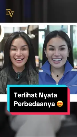 Terlihat nyata kan smile perbedaanya, ka @Nikita Mirzani Mawardi terlihat lebih muda dan tambah Cantik 😍😍 #hollywoodsmile #hollywoodsmilebydrgdevya #klinikgigiterbaik #klinikgigijakarta #klinikgigijakartaselatan #nikitamirzani #nikitamirzanimawardi_17 
