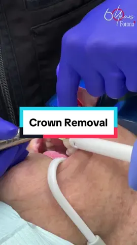 Dreading your next crown removal? 👀 Book a Fotona provider for your next dental appointment with the link in our bio! Our #dentallasers offer a faster and more efficient procedure that gets you out of the dental chair quicker! #dental #cosmeticdance #veneers #crown #mouthtaping #dentist #dentalpraxtice #crownremoval #teethwhitening #teethcare #oilpulling #cavity #veneerremoval #lasertreatment #dentallaser 