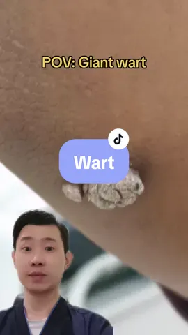 Warts are small skin growths caused by viral infections. Warts are a common skin complaint, particularly in childhood. Without medical treatment, about 65% of wart infections go away by themselves. Make sure you talk to your doctor about the risks and benefits of your chosen treatment as some cause scarring. #fyp #wart #ketuat #cryotherapy #Laser #verrumal #hpv #Dermatologist Dermatologist Penang Klinik Pakar Kulit Penang 
