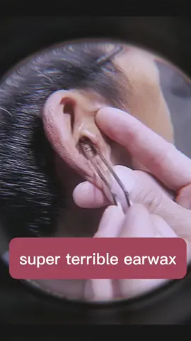 #clean #earwax #earwaxremoval #ears #wax #cleaningvideo #cleaningvideos #cleaning #wash 