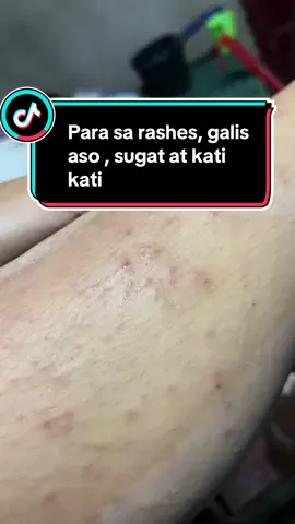 Para sa rashes, galis aso , sugat at kati kati #fyp 