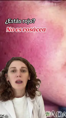 No todas las cara rojas son rosacea.  Aca te doy un ejemplo! #rosacea #skincare #redface #dermatologist #dermatologia #frio #parati #fypシ #face #piel #lacticacid 
