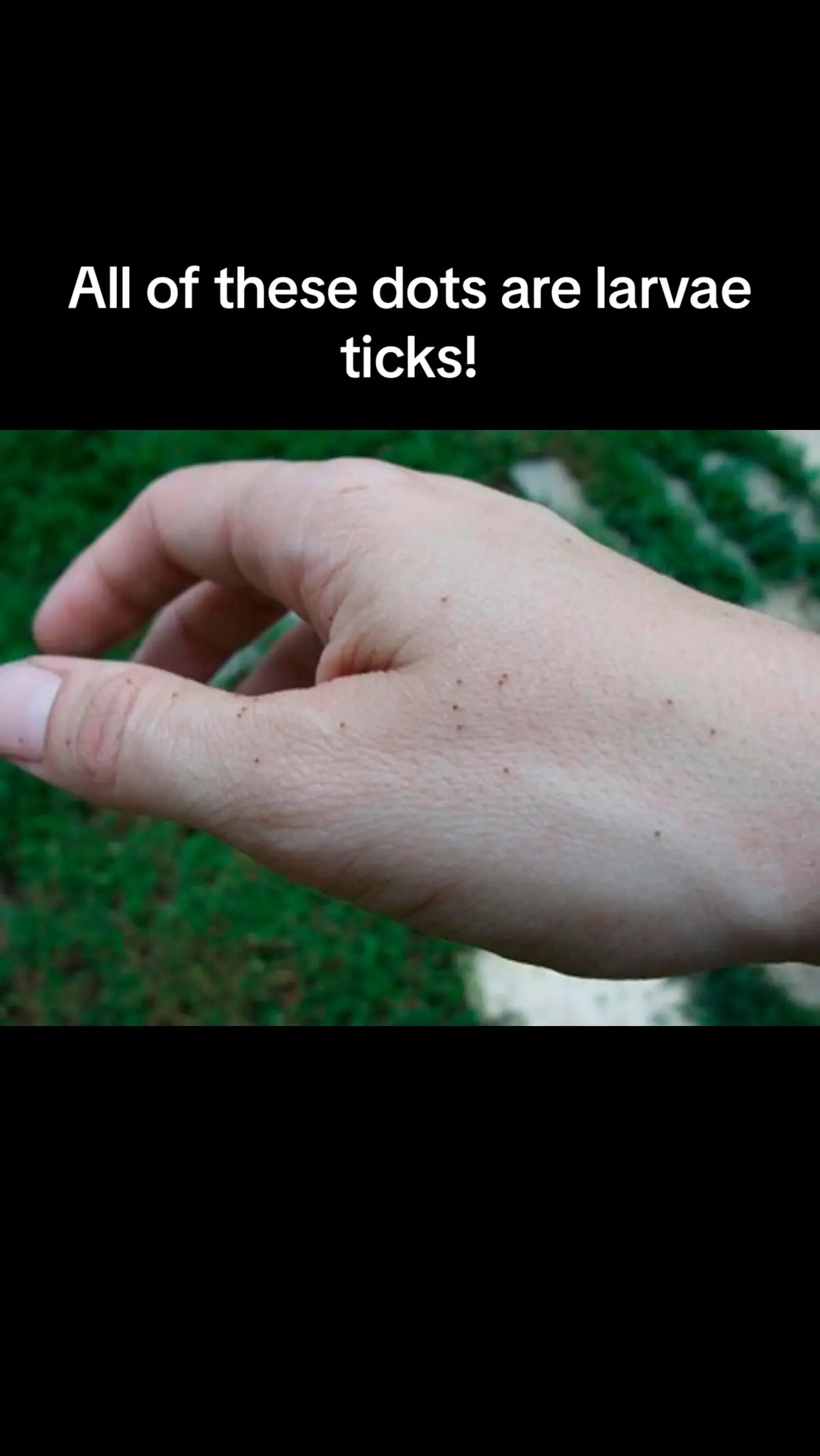 These little dots all over this hand are ticks in the larvae stage. Literally the size a freckle. Do those tick checks! #lymedisease #lymediseaseawareness #lymediseasecoinfections #ignoredincanada #lymewarrior #bartonella #babesia #POTS #mold #heavymetals #EBV #chronicillness #chroniclyme #lifeofaspoonie #awareness #educationiskey #hpylori #ignoredincanada #mystory #invisibleillness #fyp #t2d #ymediseaseawarenessmonth