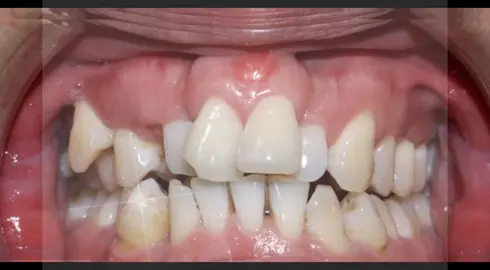 #foryou #foryoupage #fyp #viral                 [ Orthodontic Treatment ] 🖤🇵🇸🦷