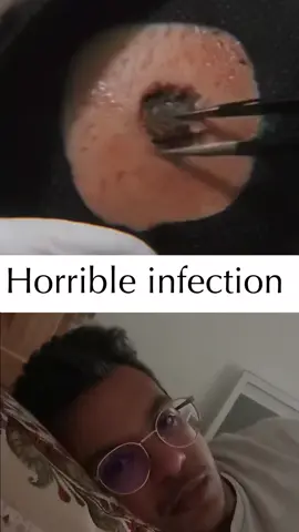 Big pimple extraction #pimple #pimples #brufoli 