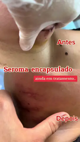 Um seroma encapsulado é uma complicação após uma cirurgia, onde líquido se acumula em uma cavidade formando uma espécie de 