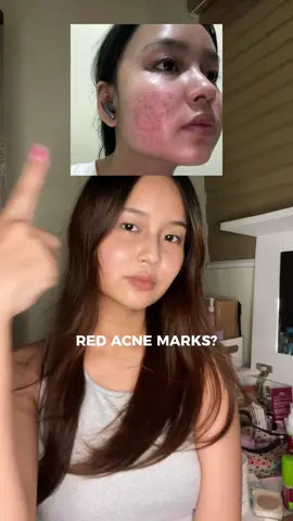 the crowd’s favorite skincare for red acne marks— skinoren azelaic acid 🤌🏼✨ #skinoren #azelaicacid #acnemarks #fyp 